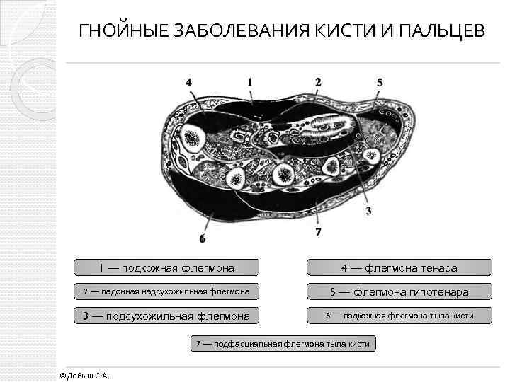 ГНОЙНЫЕ ЗАБОЛЕВАНИЯ КИСТИ И ПАЛЬЦЕВ 1 — подкожная флегмона 4 — флегмона тенара 2