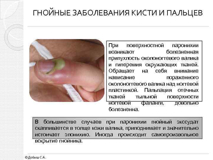 ГНОЙНЫЕ ЗАБОЛЕВАНИЯ КИСТИ И ПАЛЬЦЕВ При поверхностной паронихии возникают болезненная припухлость околоногтевого валика и