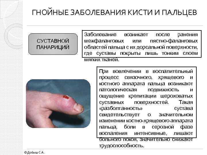 ГНОЙНЫЕ ЗАБОЛЕВАНИЯ КИСТИ И ПАЛЬЦЕВ СУСТАВНОЙ ПАНАРИЦИЙ Заболевание возникает после ранения межфаланговых или пястно-фаланговых