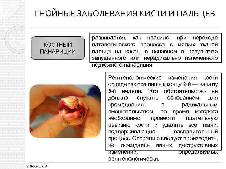 ГНОЙНЫЕ ЗАБОЛЕВАНИЯ КИСТИ И ПАЛЬЦЕВ КОСТНЫЙ ПАНАРИЦИЙ развивается, как правило, при переходе патологического процесса