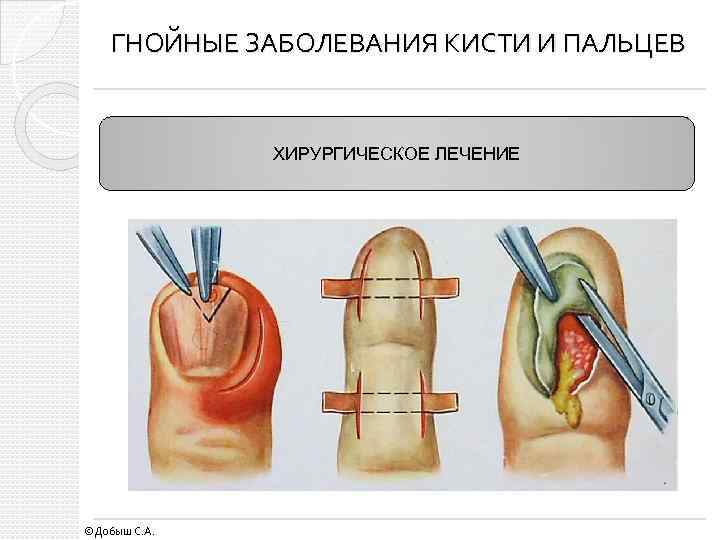 ГНОЙНЫЕ ЗАБОЛЕВАНИЯ КИСТИ И ПАЛЬЦЕВ ХИРУРГИЧЕСКОЕ ЛЕЧЕНИЕ ©Добыш С. А. 