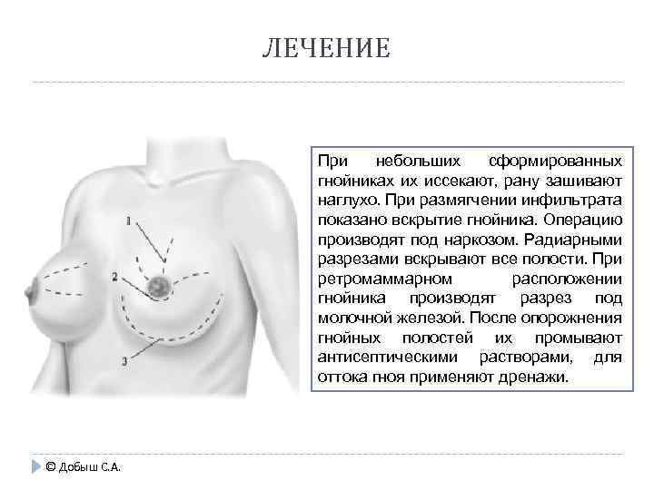 ЛЕЧЕНИЕ При небольших сформированных гнойни ах их иссекают, рану зашивают к наглухо. При размягчении