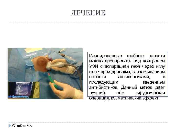 ЛЕЧЕНИЕ Изолированные гнойные полости можно дренировать под контролем УЗИ с аспирацией гноя через иглу