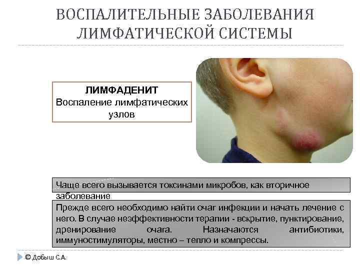 ВОСПАЛИТЕЛЬНЫЕ ЗАБОЛЕВАНИЯ ЛИМФАТИЧЕСКОЙ СИСТЕМЫ ЛИМФАДЕНИТ Воспаление лимфатических узлов Чаще всего вызывается токсинами микробов, как