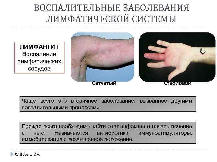 ВОСПАЛИТЕЛЬНЫЕ ЗАБОЛЕВАНИЯ ЛИМФАТИЧЕСКОЙ СИСТЕМЫ ЛИМФАНГИТ Воспаление лимфатических сосудов Сетчатый Стволовой Чаще всего это вторичное