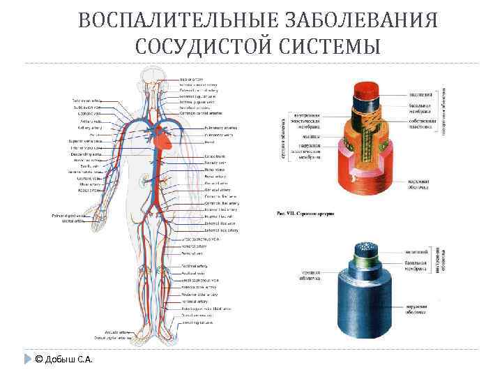 ВОСПАЛИТЕЛЬНЫЕ ЗАБОЛЕВАНИЯ СОСУДИСТОЙ СИСТЕМЫ © Добыш С. А. 