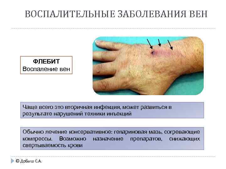 ВОСПАЛИТЕЛЬНЫЕ ЗАБОЛЕВАНИЯ ВЕН ФЛЕБИТ Воспаление вен Чаще всего это вторичная инфекция, может развиться в