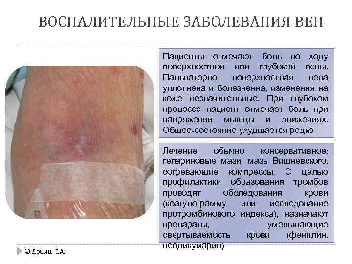 ВОСПАЛИТЕЛЬНЫЕ ЗАБОЛЕВАНИЯ ВЕН Пациенты отмечают боль по ходу поверхностной или глубо ой вены. к