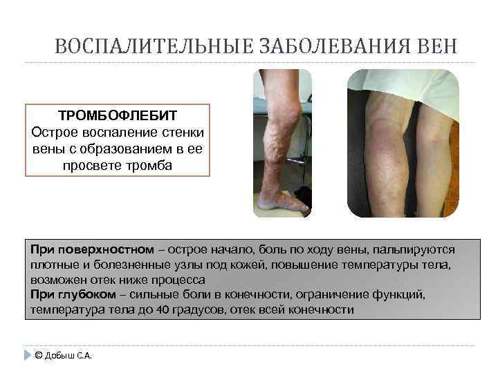 ВОСПАЛИТЕЛЬНЫЕ ЗАБОЛЕВАНИЯ ВЕН ТРОМБОФЛЕБИТ Острое воспаление стенки вены с образованием в ее просвете тромба