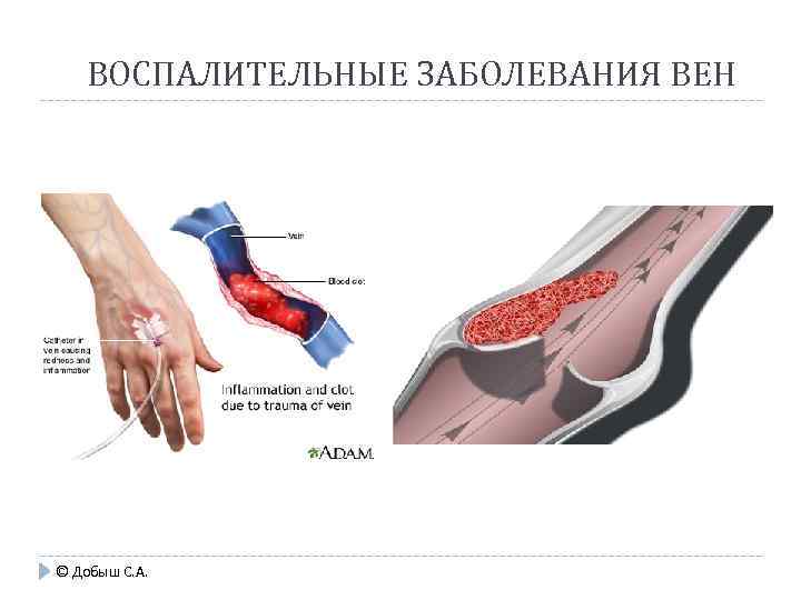 ВОСПАЛИТЕЛЬНЫЕ ЗАБОЛЕВАНИЯ ВЕН © Добыш С. А. 
