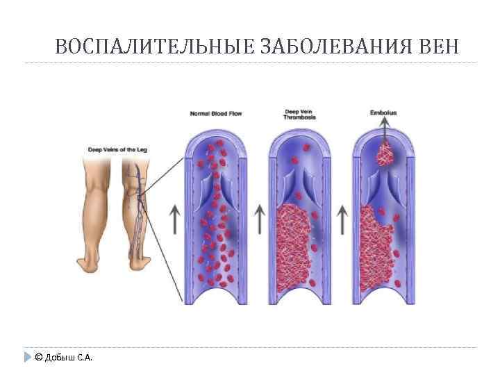 ВОСПАЛИТЕЛЬНЫЕ ЗАБОЛЕВАНИЯ ВЕН © Добыш С. А. 