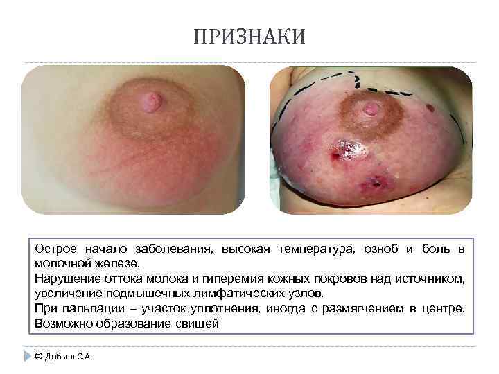 ПРИЗНАКИ Острое начало заболевания, высокая температура, озноб и боль в молочной железе. Нарушение оттока