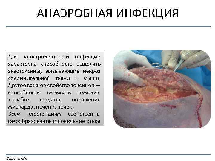 АНАЭРОБНАЯ ИНФЕКЦИЯ Для клостридиальной инфекции характерна способность выделять экзотоксины, вызывающие некроз соединительной ткани и