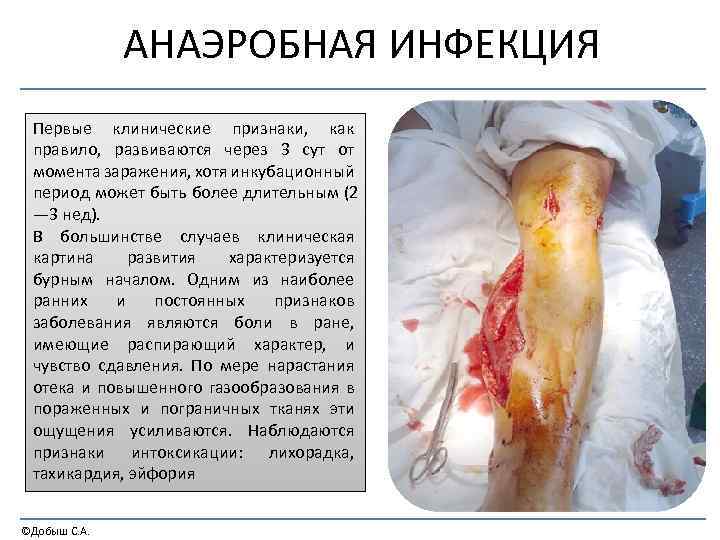 АНАЭРОБНАЯ ИНФЕКЦИЯ Первые клинические признаки, как правило, развиваются через 3 сут от момента заражения,