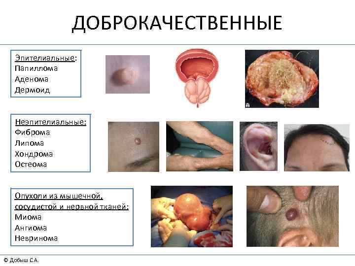 ДОБРОКАЧЕСТВЕННЫЕ Эпителиальные: Папиллома Аденома Дермоид Неэпителиальные: Фиброма Липома Хондрома Остеома Опухоли из мышечной, сосудистой
