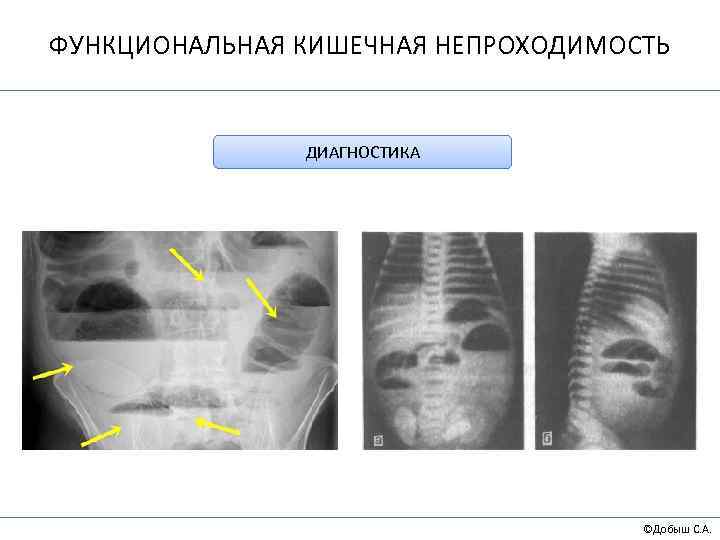 ФУНКЦИОНАЛЬНАЯ КИШЕЧНАЯ НЕПРОХОДИМОСТЬ ДИАГНОСТИКА ©Добыш С. А. 