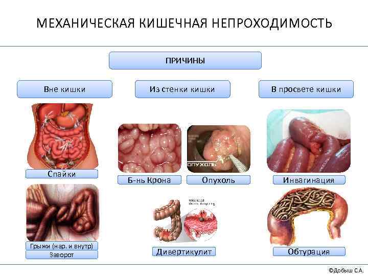 МЕХАНИЧЕСКАЯ КИШЕЧНАЯ НЕПРОХОДИМОСТЬ ПРИЧИНЫ Вне кишки Спайки Грыжи (нар. и внутр) Заворот Из стенки