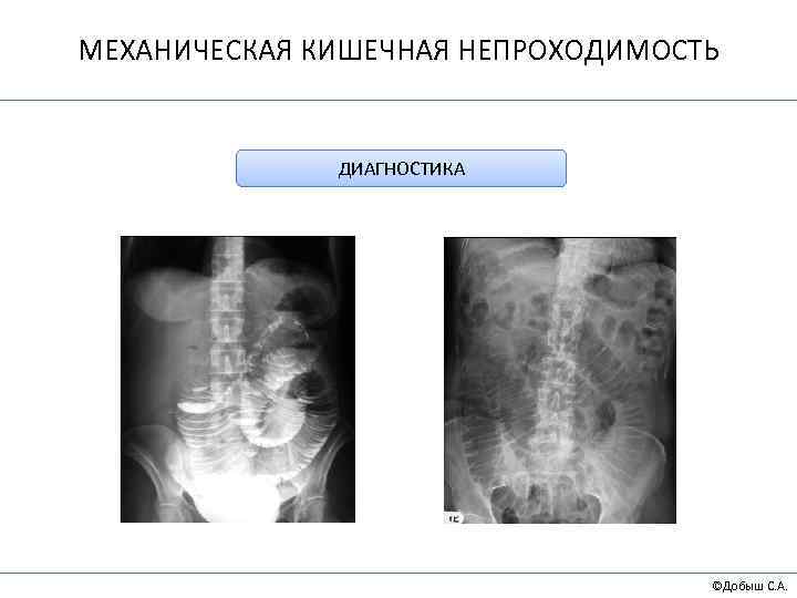 МЕХАНИЧЕСКАЯ КИШЕЧНАЯ НЕПРОХОДИМОСТЬ ДИАГНОСТИКА ©Добыш С. А. 