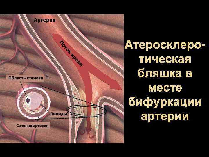 Атеросклеротическая бляшка в месте бифуркации артерии 