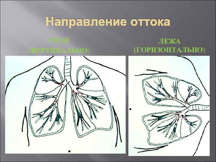 Направление оттока СИДЯ (ВЕРТИКАЛЬНО) ЛЕЖА (ГОРИЗОНТАЛЬНО) 
