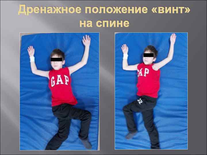 Дренажное положение «винт» на спине 