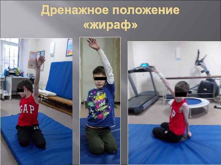 Дренажное положение «жираф» 