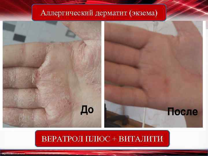 Аллергический дерматит (экзема) ВЕРАТРОЛ ПЛЮС + ВИТАЛИТИ http: //linda 6035. ucoz. ru/ 
