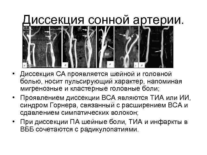 Диссекция сонной артерии. • Диссекция СА проявляется шейной и головной болью, носит пульсирующий характер,