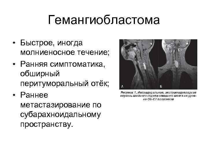 Гемангиобластома • Быстрое, иногда молниеносное течение; • Ранняя симптоматика, обширный перитуморальный отёк; • Раннее
