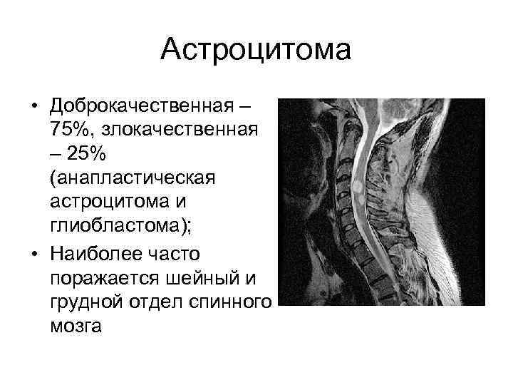 Астроцитома • Доброкачественная – 75%, злокачественная – 25% (анапластическая астроцитома и глиобластома); • Наиболее