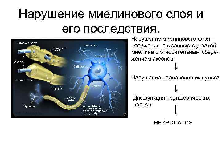 Нарушение миелинового слоя и его последствия. Нарушение миелинового слоя – поражения, связанные с утратой