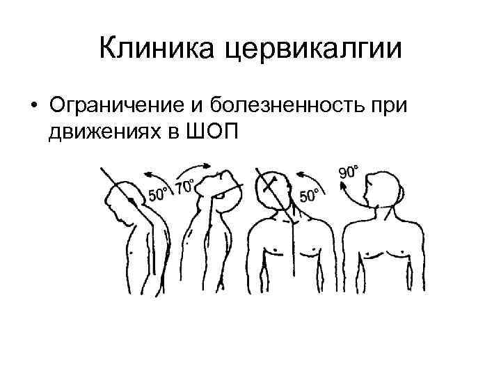 Клиника цервикалгии • Ограничение и болезненность при движениях в ШОП 