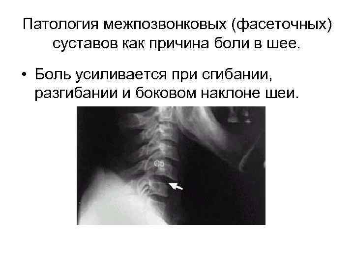 Патология межпозвонковых (фасеточных) суставов как причина боли в шее. • Боль усиливается при сгибании,