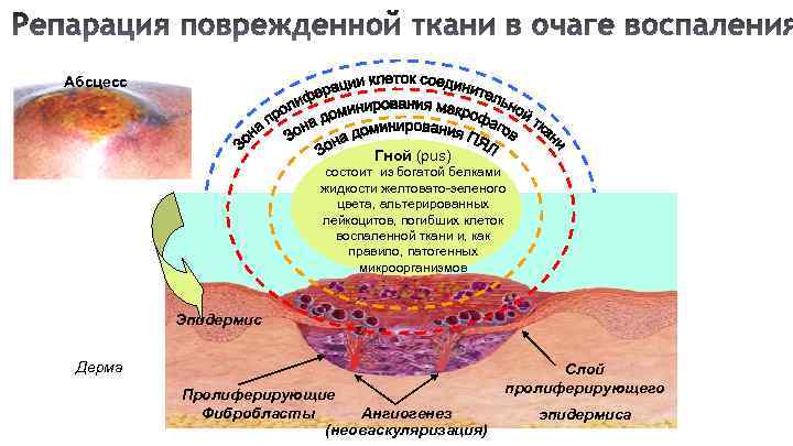 Из чего состоит стенка абсцесса