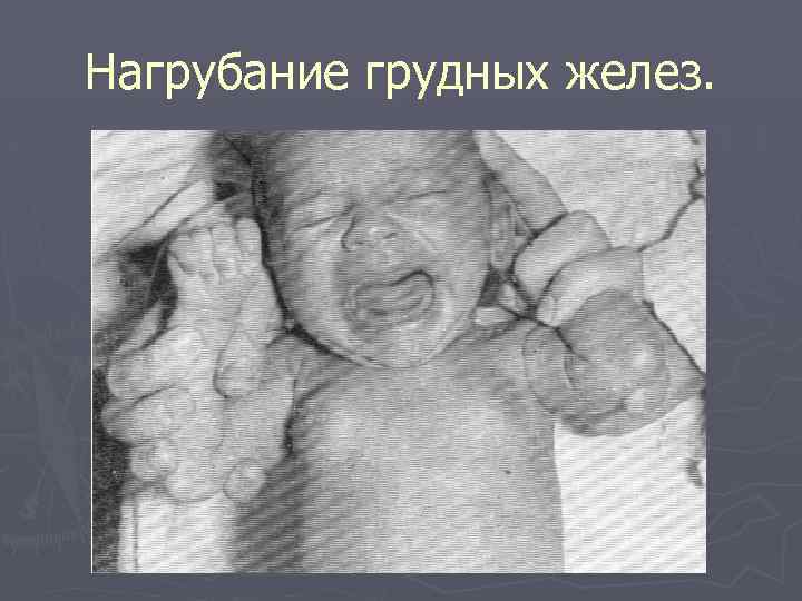 Нагрубание грудных желез. 