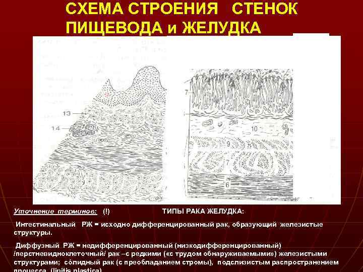 СХЕМА СТРОЕНИЯ СТЕНОК ПИЩЕВОДА и ЖЕЛУДКА. . Уточнение терминов: (!) . . ТИПЫ РАКА