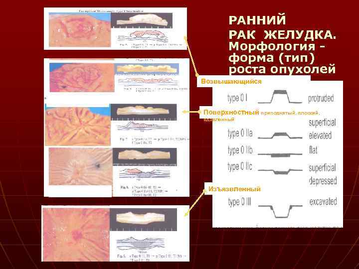 РАННИЙ РАК ЖЕЛУДКА. Морфология форма (тип) роста опухолей Возвышающийся Поверхностный приподнятый, плоский, вдавленный Изъязвленный
