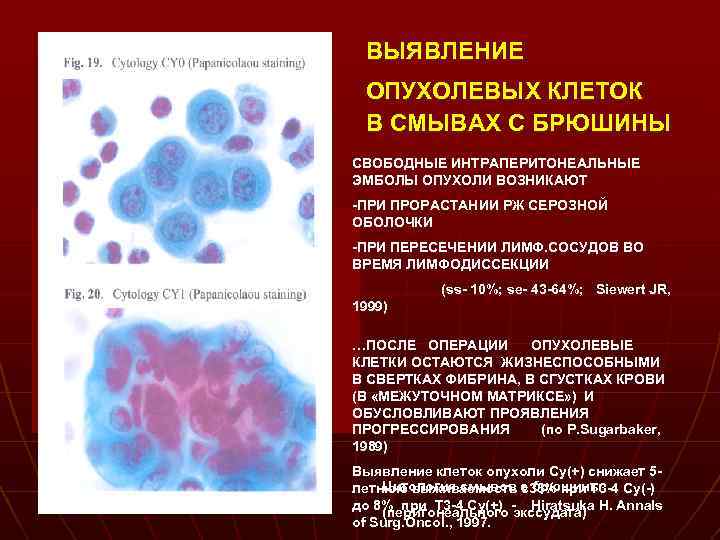 ВЫЯВЛЕНИЕ ОПУХОЛЕВЫХ КЛЕТОК В СМЫВАХ С БРЮШИНЫ СВОБОДНЫЕ ИНТРАПЕРИТОНЕАЛЬНЫЕ ЭМБОЛЫ ОПУХОЛИ ВОЗНИКАЮТ -ПРИ ПРОРАСТАНИИ