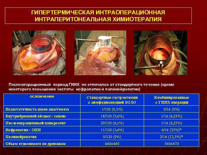 ГИПЕРТЕРМИЧЕСКАЯ ИНТРАОПЕРАЦИОННАЯ ИНТРАПЕРИТОНЕАЛЬНАЯ ХИМИОТЕРАПИЯ Послеоперационный период ГИИХ не отличался от стандартного течения (кроме некоторого