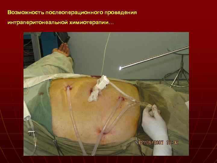 Возможность послеоперационного проведения интраперитонеальной химиотерапии… 
