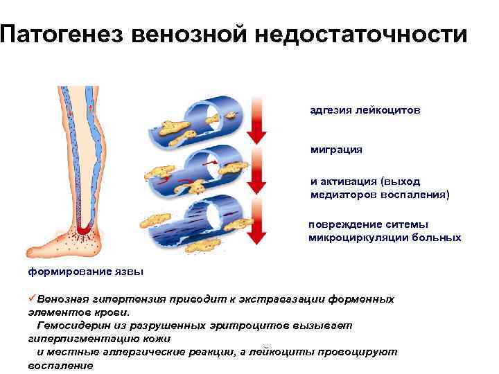 Как лечить венозную недостаточность