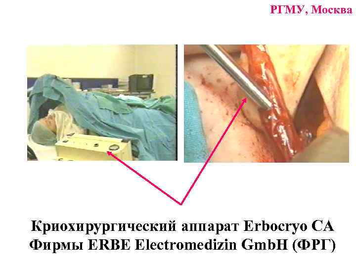 РГМУ, Москва Криохирургический аппарат Erbocryo CA Фирмы ERBE Electromedizin Gmb. H (ФРГ) 