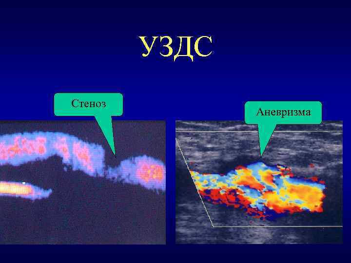 УЗДС Стеноз Аневризма 