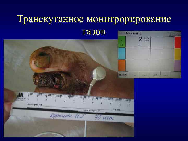 Транскутанное монитрорирование газов 