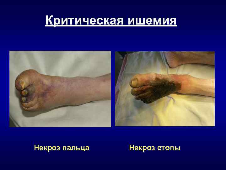 Критическая ишемия Некроз пальца Некроз стопы 