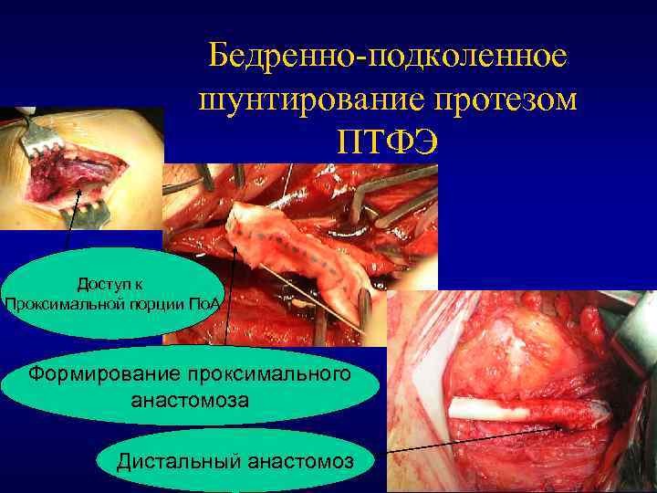 Бедренно-подколенное шунтирование протезом ПТФЭ Доступ к Проксимальной порции По. А Формирование проксимального анастомоза Дистальный