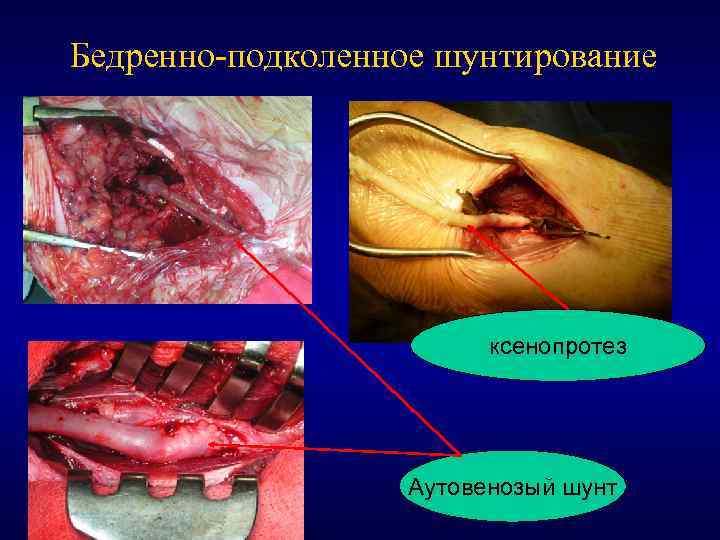 Бедренно-подколенное шунтирование ксенопротез Аутовенозый шунт 