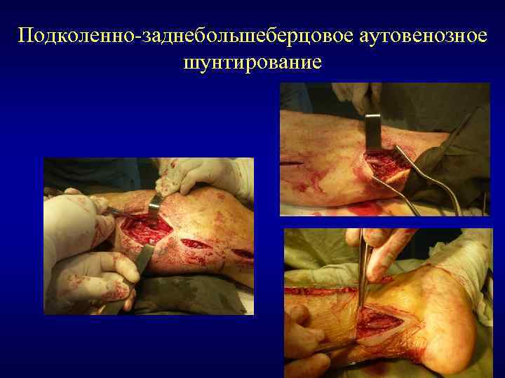 Подколенно-заднебольшеберцовое аутовенозное шунтирование 