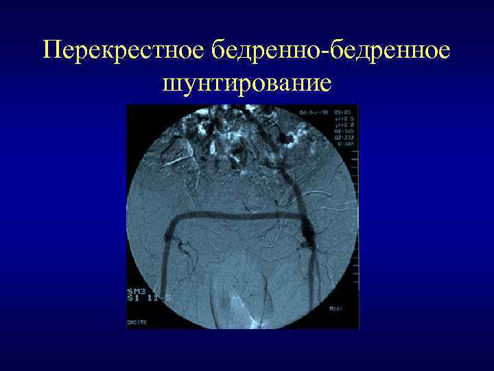 Перекрестное бедренно-бедренное шунтирование 
