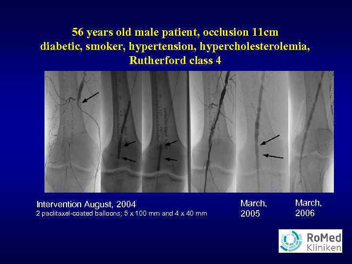 56 years old male patient, occlusion 11 cm diabetic, smoker, hypertension, hypercholesterolemia, Rutherford class